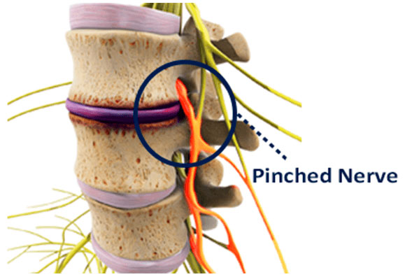 pinched-nerve-in-shoulder-symptoms-causes-and-effective-treatments